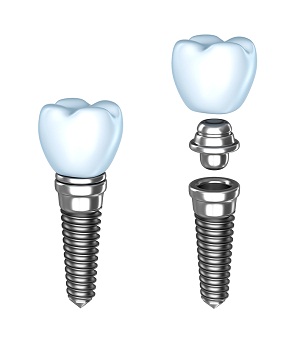 Dental Implants Alexandria, VA